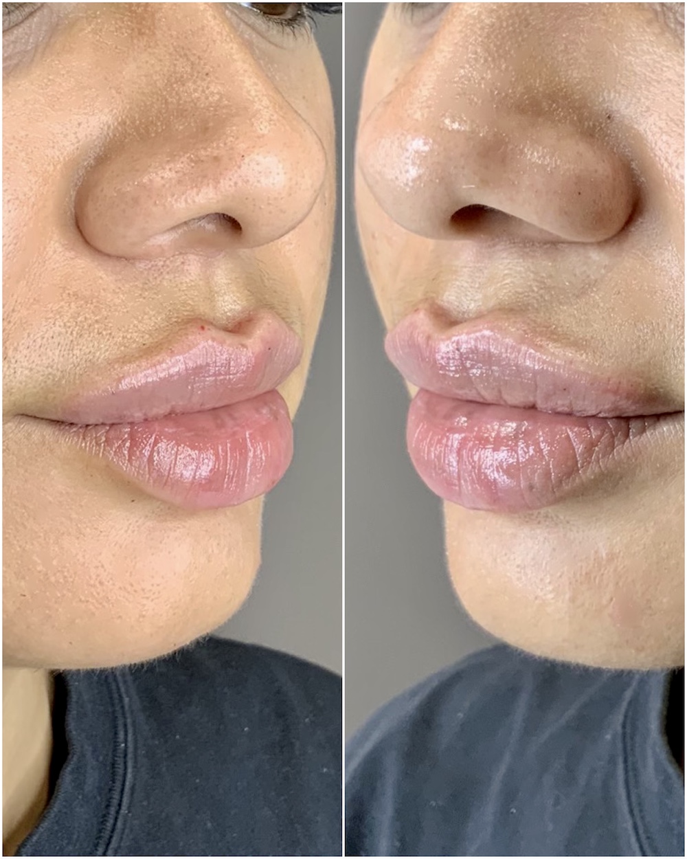 Russian Lip Filler Before and After
